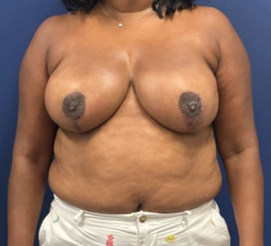 Breast-Reduction-Case--28242 | After Dr. Samir Rao 1