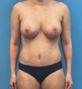Breast-Augmentation-Tummy-Tuck-Case--28080 | After Body 1
