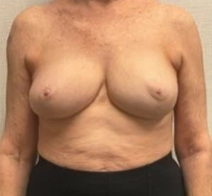 Breast-Reconstruction-Case--24804 | After Dr. Frank Albino 1