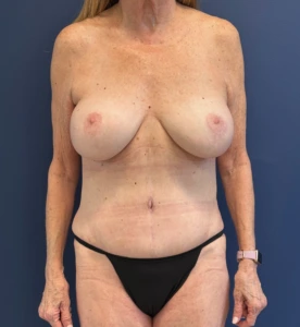 Lipoabdominoplasty-Case--27935 | After Body 1
