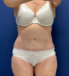 Abdominoplasty-Case--23690 | After Liposuction 1