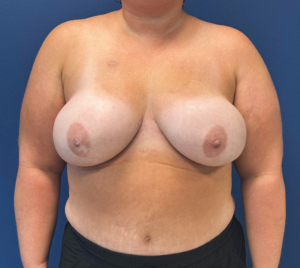 DIEP-Flap-Case--27595 | After DIEP Flap 1