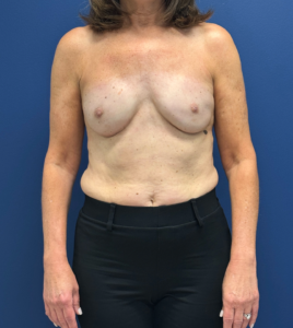 Breast-Reconstruction-Case--28688 | After Dr. Samir Rao 1