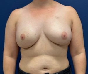 Breast-Reconstruction-Case--28689 | After Breast Reconstruction 1