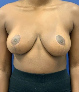 Breast-Reduction-Case--27254 | After Breast Reduction 1