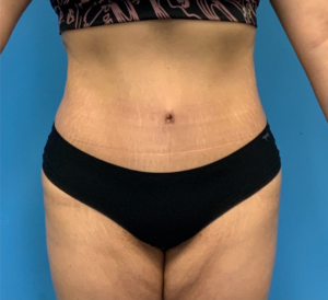 Abdominoplasty-Case--23747 | After Tummy Tuck 1