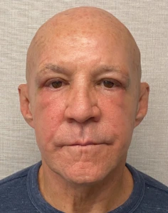 Blepharoplasty-Case--24169 | After Face 2