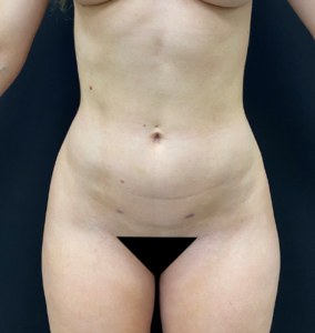 Brazilian-Butt-Lift-Case--366 | After Liposuction 1