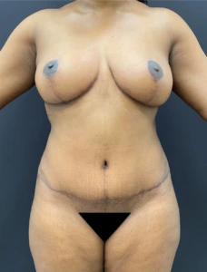 Mommy-makeover-Case--336 | After Body 1