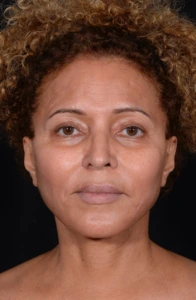 Facelift-Case--360 | After Face 1