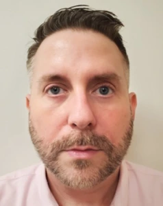 Lower-Blepharoplasty-Case--359 | After Dr. Arjun Kanuri 1