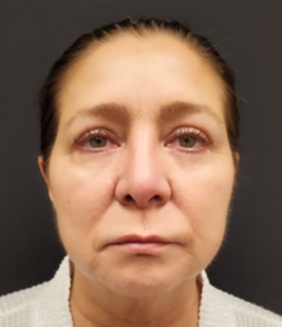 Quad-Blepharoplasty-Case--358 | After Eyelid Surgery 1