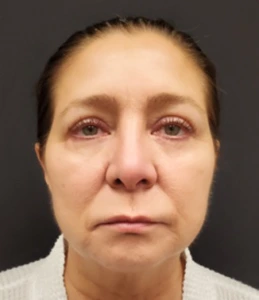 Quad-Blepharoplasty-Case--358 | After Face 1