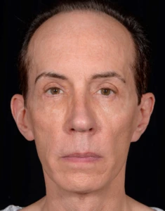 Quad-Blepharoplasty-Case--357 | After Face 1