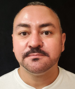 Liposuction-Case--368 | After Submental Liposuction 1