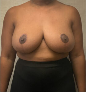 Breast-Reduction-Case--2564 | After Breast Reduction 1