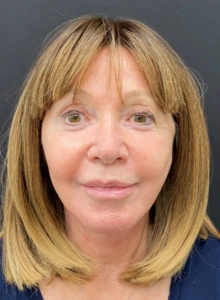 Facelift-Case--365 | After Face 1