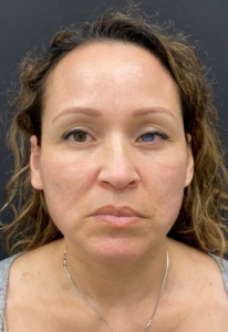 Facelift-Case--364 | After Face 1