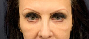 Blepharoplasty-Case--6272 | After Eyelid Surgery 1