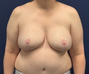 Breast-Reconstruction-DIEP-Flap-Case--26029 | After Breast Reconstruction 1