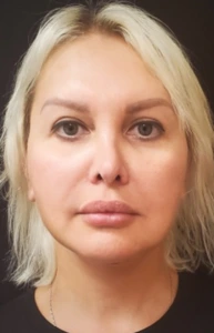 Facelift-Case--362 | After Face 1