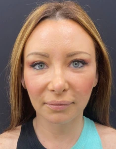 Facelift-Case--355 | After Face 1