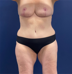 Mommy-Makeover-Case--26853 | After Mommy Makeover 1