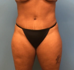 Case--247 | After Body 1