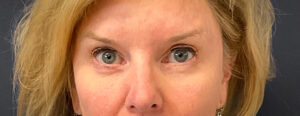 Blepharoplasty-Case--7015 | After Eyelid Surgery 1