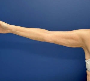 Liposuction-Case--23690-2 | After Body 2