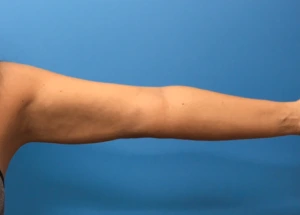 Case--280 | After Body 2