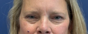 Blepharoplasty-Case--13622 | After Face 2