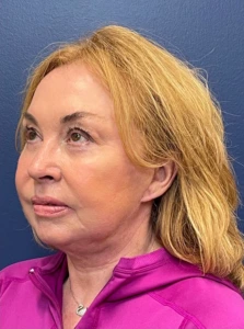 Facelift-Case--22860 | After Face 2