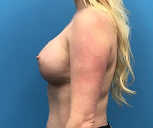 Case--94 | After Breast Augmentation 2