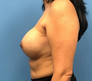 Case--134 | After Breast Reconstruction 2