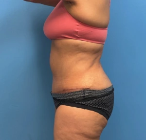 Lipoabdominoplasty-Case--27602 | After Body 2