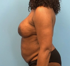 Breast-Reconstruction-Case--23930 | After Breast Reconstruction 2