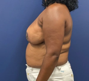 Breast-Reduction-Case--28242 | After Dr. Samir Rao 2