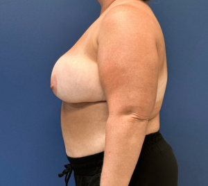 DIEP-Flap-Case--27595 | After DIEP Flap 2