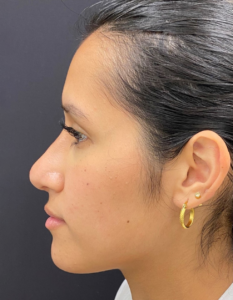 Rhinoplasty-Case--376 | After Rhinoplasty 2