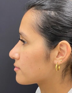 Rhinoplasty-Case--376 | After Face 2