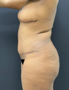 Mommy-makeover-Case--336 | After Body 2