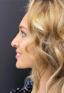 Rhinoplasty-Case--378 | After Face 2