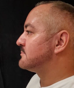 Liposuction-Case--368 | After Face 2