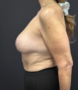 Breast-Reduction-Case--2538 | After Dr. Arjun Kanuri 2