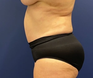 Abdominoplasty-Case--21804 | After Body 2