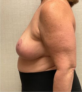 Breast-Reduction-Case--26425 | After Breast Reduction 2