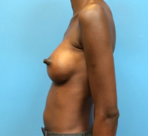 Case--97 | After Breast Augmentation 2