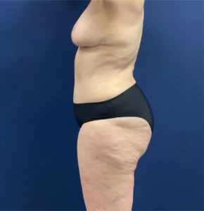 Mommy-Makeover-Case--26853 | After Body 2