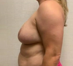 Breast-Reconstruction-Case--26525 | After Dr. Frank Albino 2